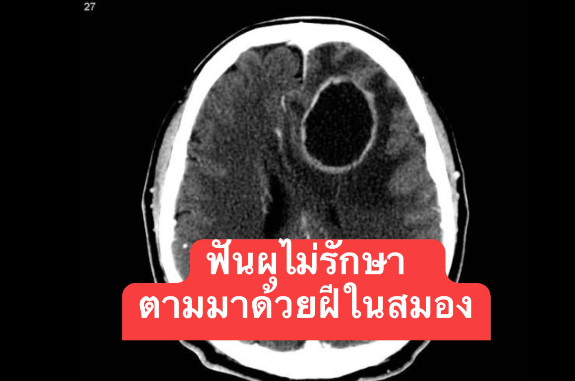 8031166-1 ▲▼婦人蛀牙引發腦膿瘍。(圖/翻攝自Facebook/สาระสมองกับ อจ.หมอสุรัตน์)