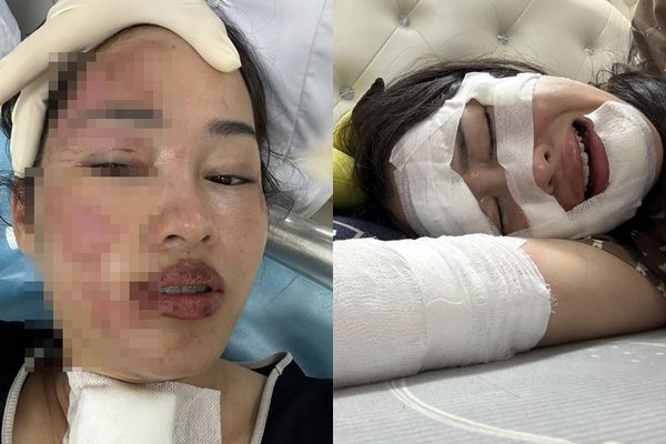 d8094923 ▲▼慶生氣球「碰到蠟燭」爆炸! 她半邊臉燒到冒煙。(圖/翻攝自Facebook/Giang Phạm)