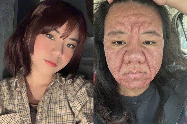 d8358288-1 ▲▼大馬女子法拉(Farah Faizal)懷孕後荷爾蒙變化導致她滿臉痘痘、鼻子腫大。(圖/翻攝自X、IG)