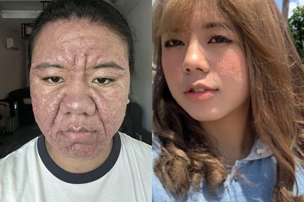 d8358290-1 ▲▼大馬女子法拉(Farah Faizal)懷孕後荷爾蒙變化導致她滿臉痘痘、鼻子腫大。(圖/翻攝自X、IG)
