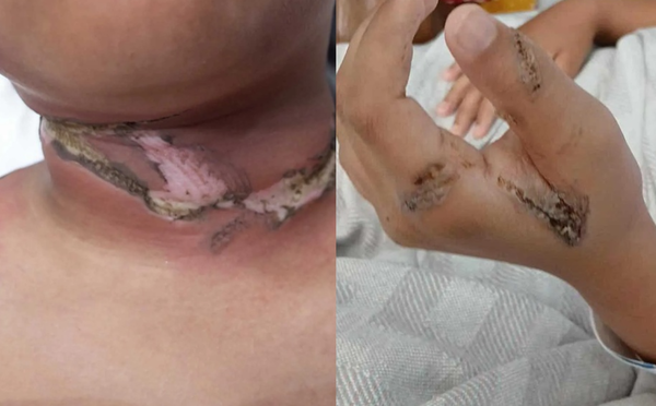d8471513 金屬項鍊纏充電線突然起火 男童睡夢中「脖子嚴重燒傷」送醫。(圖/翻攝自Facebook)