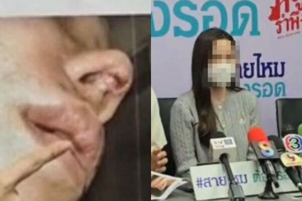 ▲▼網美整形「慘變豬鼻」！鼻子爛出一個洞　求償無門。（圖／翻攝自Facebook／สาวน้อยร้อยข่าว）