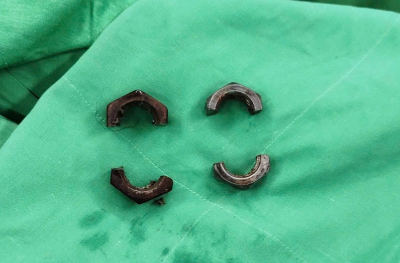 ▲▼男2顆螺帽「掐住生殖器」1個月　忍痛1個月下場曝光。（圖／芹苴中央綜合醫院）