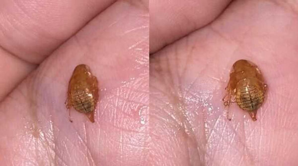 d8700691 男友喉嚨卡3天咳出「詭異生物」嚇壞 全網見畫面抖爆:不如不知道